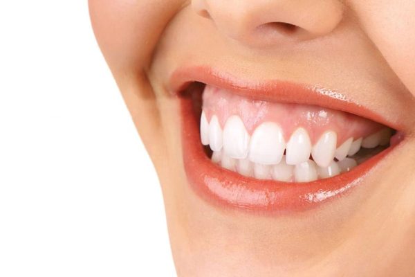 Hở nướu là tình trạng nướu bị lộ ra ngoài quá nhiều khi cười, gây mất cân đối tổng thể giữa răng và nướu.