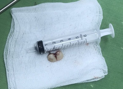 Quảng Ninh: Bệnh nhân cấp cứu với 2 chiếc răng giả trong phế quản