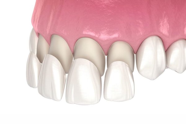 Veneers được gắn vào răng thật bằng keo chuyên dụng để chỉnh sửa một số khuyết điểm của răng