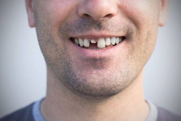 Răng bị gãy, chấn thương, viêm tủy răng nếu không được điều trị kịp thời có thể dẫn đến mất răng.