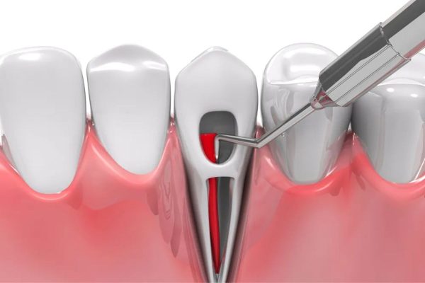 Điều trị tủy răng bị viêm không đau nhờ công nghệ hiện đại