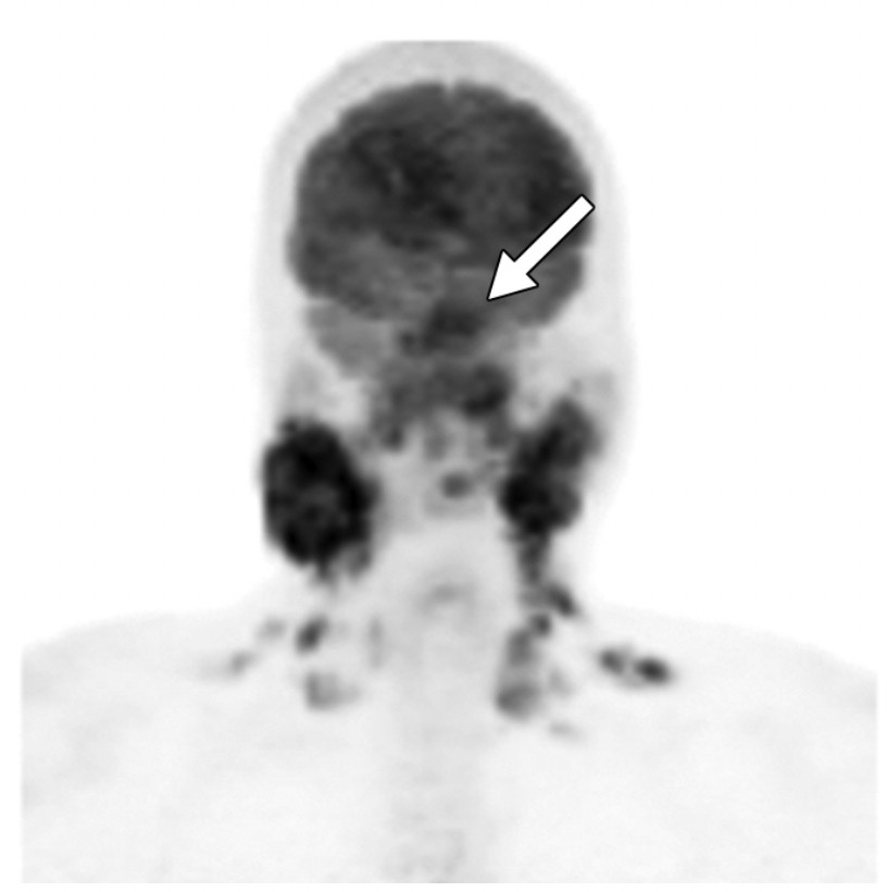 Chụp PET nam bệnh nhân 25 tuổi được chẩn đoán ung thư vòm họng với tăng hoạt độ phóng xạ vùng vòm họng, hạch cổ hai bên và hạch thượng đòn.