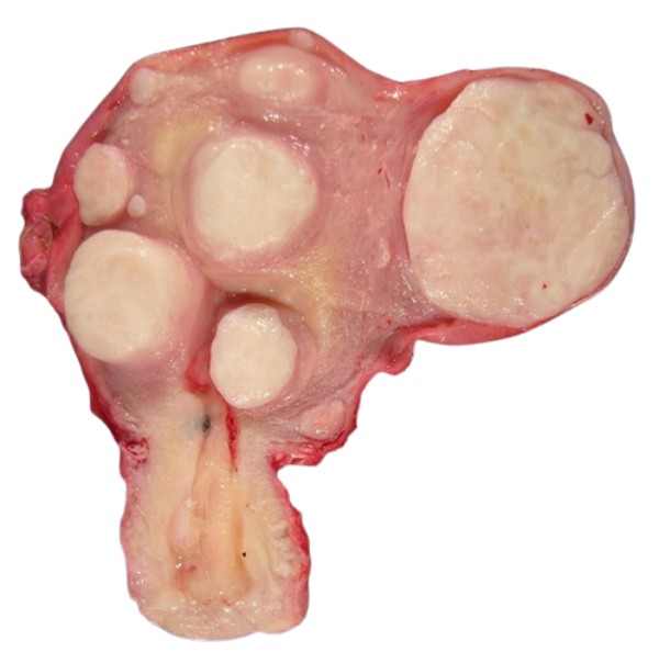 Hình ảnh tử cung có nhiều u xơ, có những khối u xơ nằm sát lòng tử cung.