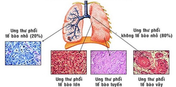 Hình: Các loại mô học của ung thư phổi