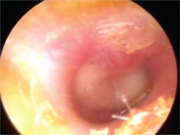 Hình ảnh nội soi tai cho thấy màng nhĩ căng phồng, xung huyết đỏ.